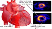 Xạ hình tưới máu cho tim