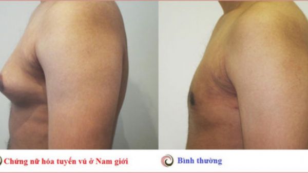 Nữ hóa tuyến vú ở nam giới