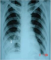Áp xe đáy phổi phải có dạng đám mờ trên phim phổi thẳng