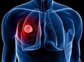Áp xe phổi phải có mức nước hơi trên phim phổi nghiêng phải và CT