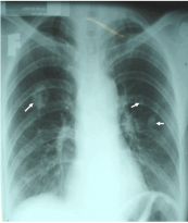 Bệnh bụi phổi (Silicosis) trên phim x quang