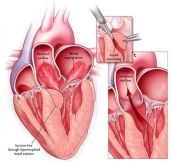 Bệnh cơ tim phì đại vùng đỉnh trên điện tâm đồ