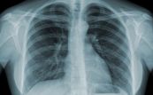 Bệnh phổi tắc nghẽn mạn tính (COPD) trên x quang