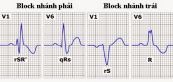 Block nhánh phải và block nhánh trái trước trên điện tâm đồ