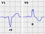 Block nhánh trên điện tâm đồ