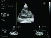 Mặt cắt quét dưới mũi ức trục dài