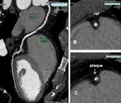 Chụp CT scan mạch vành