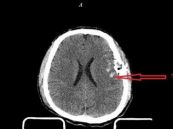 Dập não và dập não kèm xuất huyết