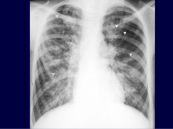 Giãn phế quản dạng ngón tay đi găng