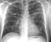 Giãn phế quản gây tâm phế mạn