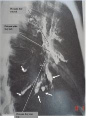 Giãn phế quản hình trụ