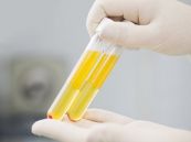 Huyết thanh học chẩn đoán virus viêm gan (A, B, C, D, E): ý nghĩa chỉ số xét nghiệm