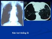 Kén hơi khổng lồ phổi trái