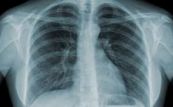 Lao phổi trên chẩn đoán hình ảnh
