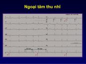 Ngoại tâm thu nhĩ không dẫn trên hình ảnh điện tâm đồ
