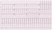 Nhịp tim nhanh vào lại nhĩ thất (AVRT) và kịch phát trên thất (PSVT)