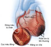 Nhồi máu cơ tim vùng trước bên trên điện tâm đồ