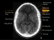 Nhồi máu tiểu não