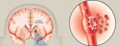 Nhũn não động mạch não giữa