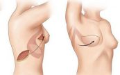 Phẫu thuật giảm vú