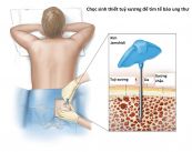 Sinh thiết tủy xương và hút tủy