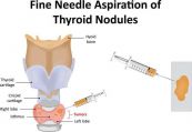 Sinh thiết tuyến giáp: ý nghĩa lâm sàng kết quả thủ thuật