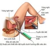 Sinh thiết tuyến tiền liệt
