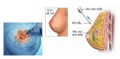 Sinh thiết vú: ý nghĩa lâm sàng kết quả sinh thiết