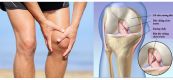 Tái thiết dây chằng chéo trước (ACL)