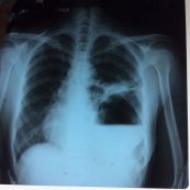 Thoát vị hoành trái và thoát vị dạ dày