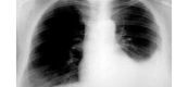 Tràn dịch màng phổi trên hình ảnh