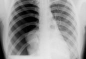 Tràn khí màng phổi trên hình ảnh