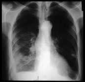 Tràn mủ màng phổi trên hình ảnh
