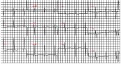 Trục điện tim lệch phải ở bệnh nhân thông liên nhĩ lỗ thứ hai