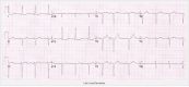 Trục điện tim lệch trái ở bệnh nhân thông liên nhĩ lỗ thứ nhất