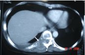 Ung thư phổi thứ phát kiểu thả bóng trên phim chụp phổi thẳng, CT scan