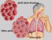 Viêm phổi gây tràn dịch màng phổi ở bệnh nhân Collagenose