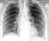 Viêm phổi kẽ trên phim CT scaner