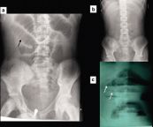X quang bụng: ý nghĩa lâm sàng hình ảnh x quang