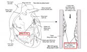 Xạ hình tưới máu tim: ý nghĩa lâm sàng giá trị kết quả