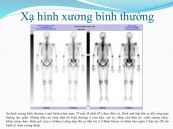 Xạ hình xương: ý nghĩa lâm sàng giá trị kết quả