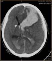 Xuất huyết não và não thất