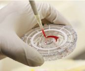 Yếu tố thấp khớp (RF): ý nghĩa lâm sàng kết quả xét nghiệm