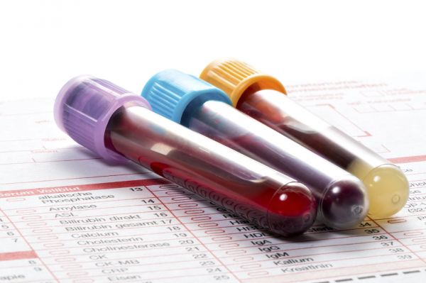 Amoniac máu: ý nghĩa lâm sàng chỉ số xét nghiệm