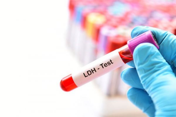 Axit lactic Dehydrogenase (LDH): ý nghĩa lâm sàng chỉ số xét nghiệm