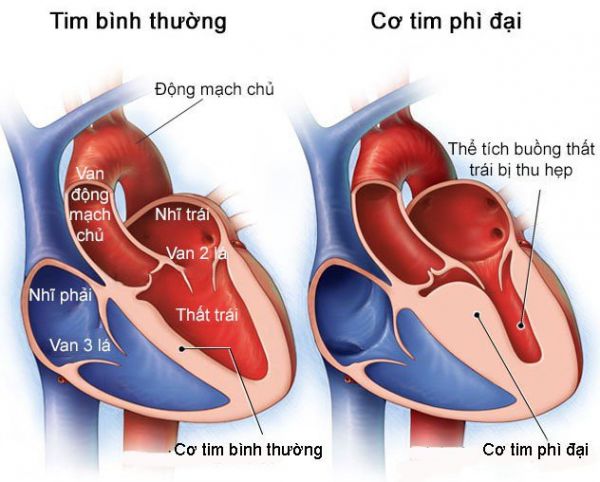 Bệnh cơ tim phì đại trên điện tâm đồ