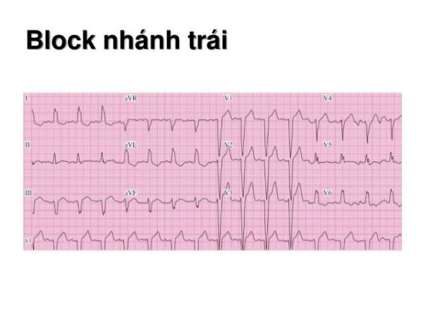 Block nhánh trái sau và block nhánh phải