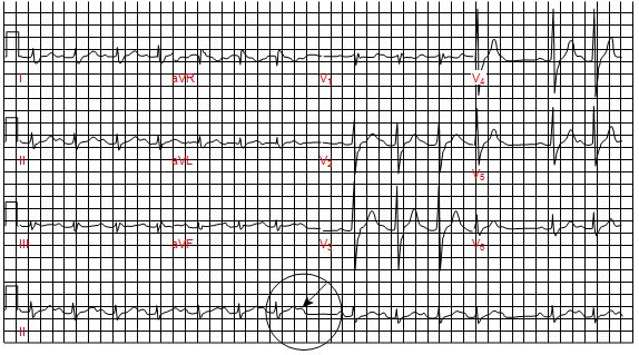 Block nhĩ thất độ 2 Mobitz loại II trên điện tâm đồ