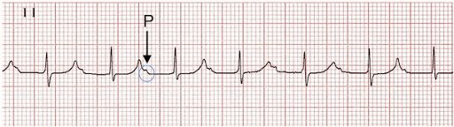 Block nhĩ thất hoàn toàn, block nhánh phải, QT kéo dài và nhịp tim nhanh thất đa hình thái ở bệnh nhân nhồi máu cơ tim cấp