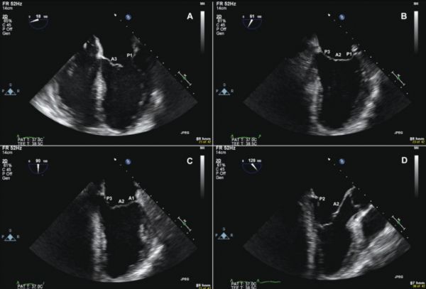 Mặt cắt 3 buồng tim từ mỏm